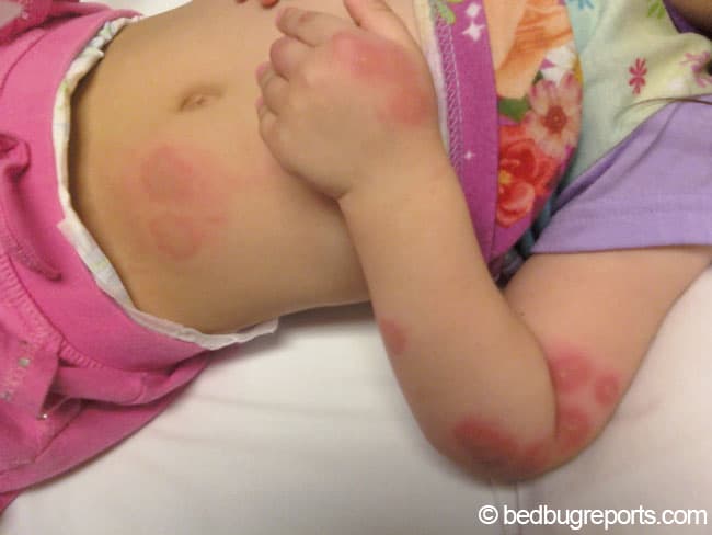 bed bug bites on babies neck